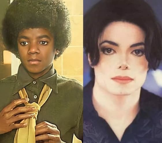 Michael Jackson Did Not Bleach His Skin to Appear White - Vitiligo